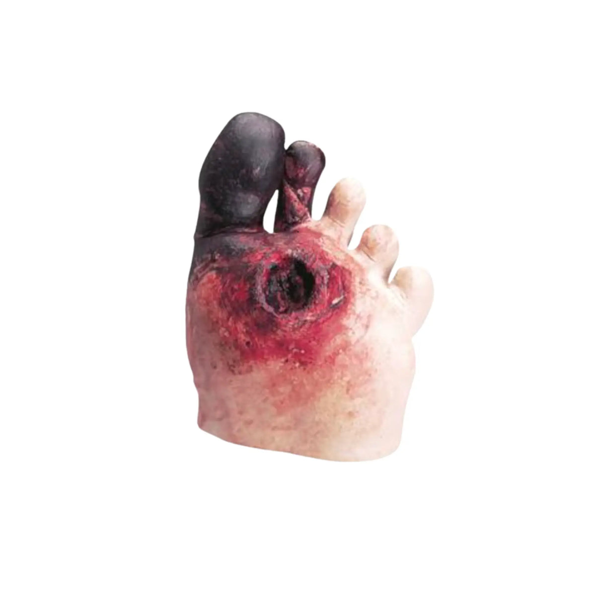 Modèle de pied diabétique avec plaie - Life form 3B Scientific 